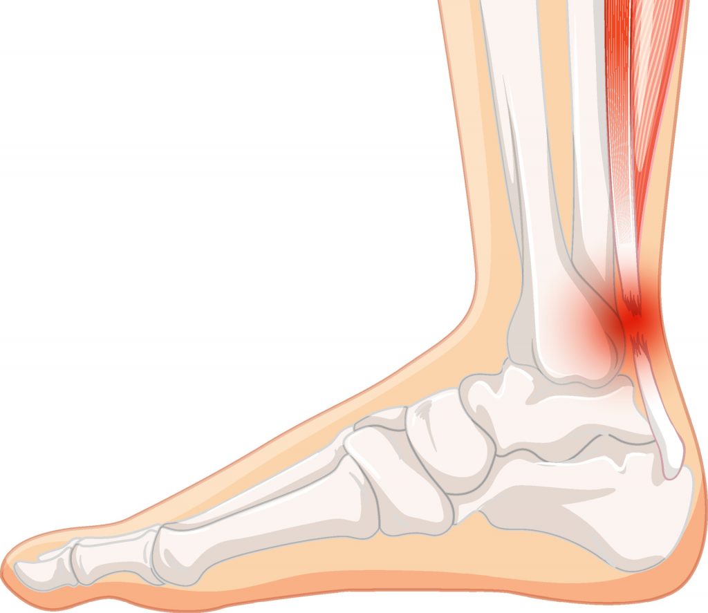 Achilles Tendinopathy Life In Motion Chiropractic