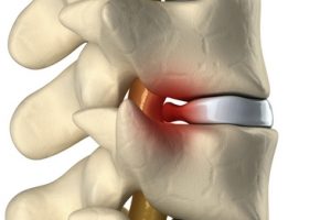 lumbar disc herniation