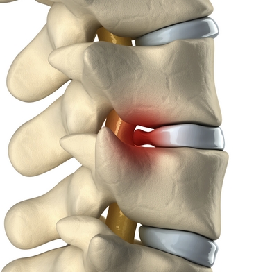 Diagram of a lumbar disc herniation pressing on spinal nerves