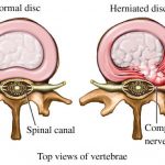 disc herniation model