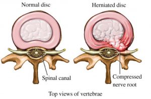 disc herniation model