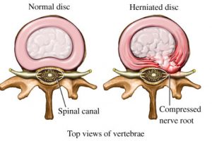 disc herniation model