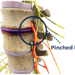 pinched nerve in the neck