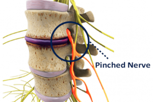 pinched nerve in the neck