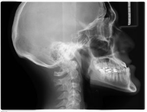 x-ray of neck pain