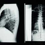 chiropractic scoliosis